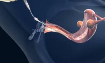 确诊为免疫性不孕能在赤壁市做试管婴儿吗？做三代试管需要多少钱？